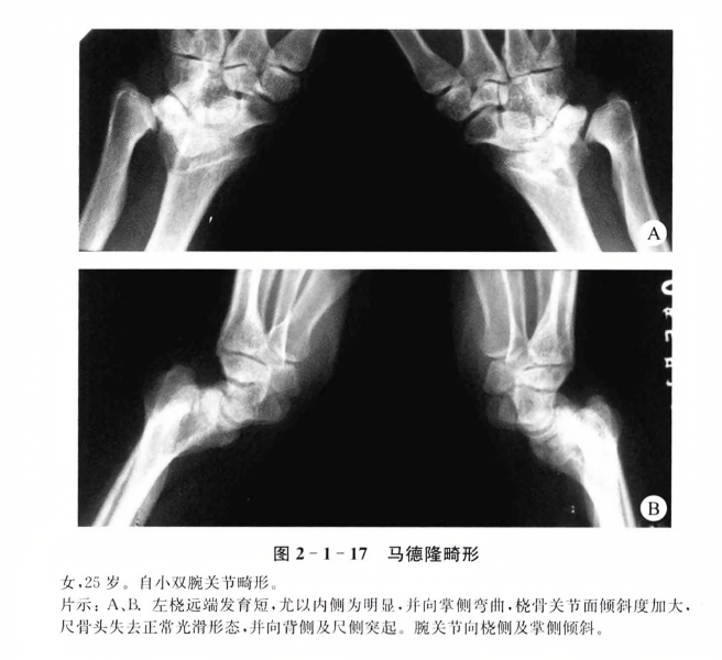 马德隆畸形最新治疗指南及详细步骤解析